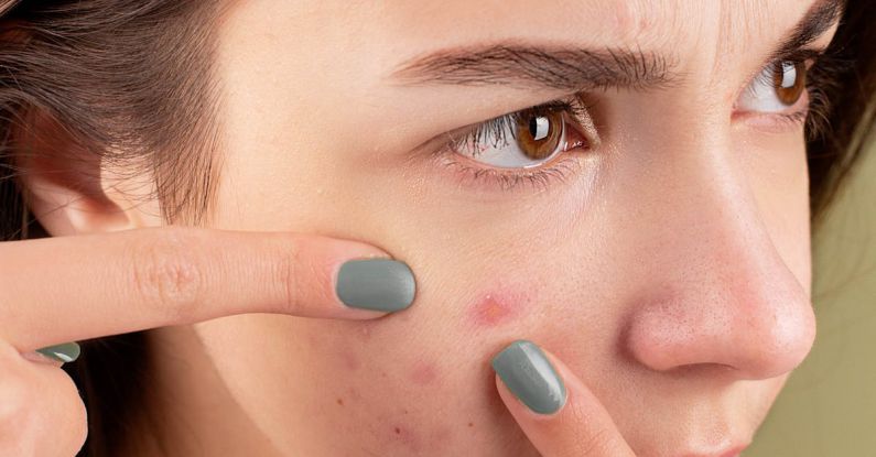 Acne - Woman Squeezing Her Pimples with Her Fingers