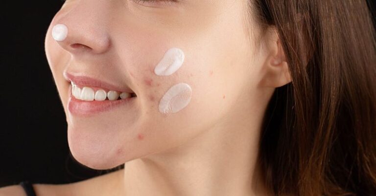 Acne Treatment - Woman Applying Facial Cream